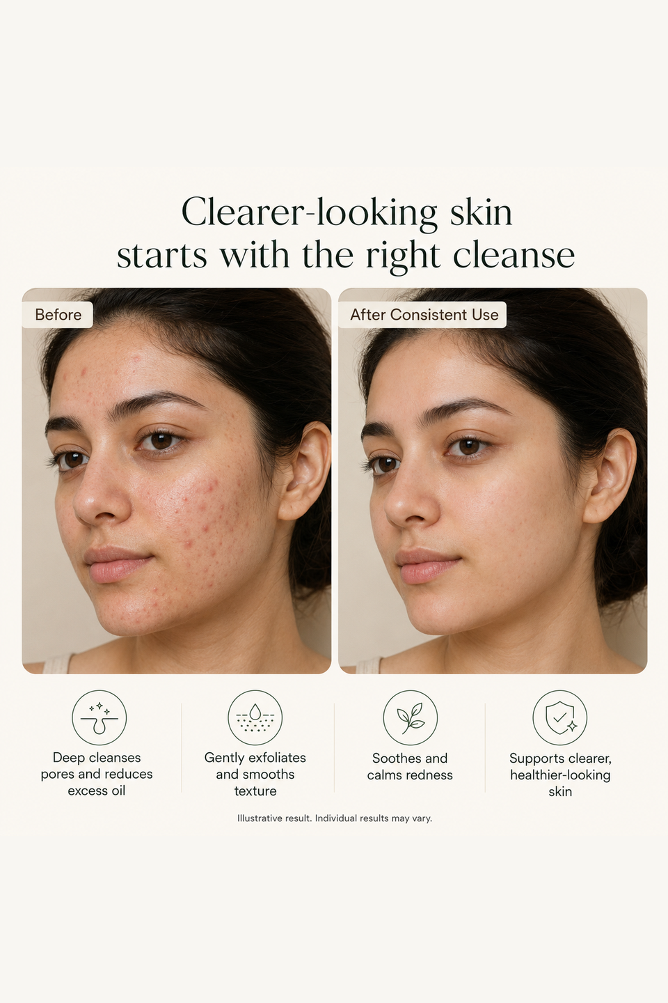 Anti Acne Face Wash
